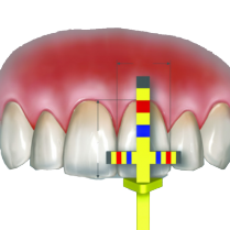 950-TBARREF Hu-Friedy Chu Gauge T-Bar Tip Refill (3)