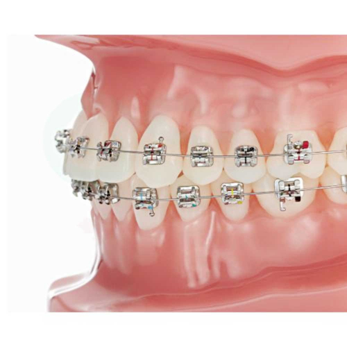 Typodont BioQuick Roth System 2.0 Bracket - OSC