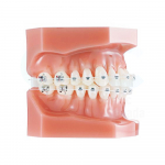 QuicKlear III Brackets Typodont