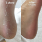 Footlogix Peeling Skin Formula Mousse (7) 4.23 oz.  20131