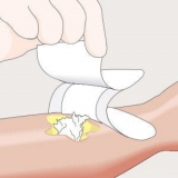 Mesalt&reg; Sodium Chloride Dressings
